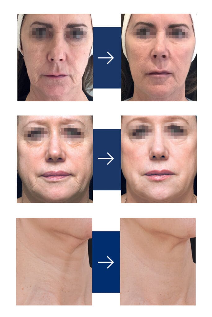 tretman-za-podmladjivanje-lica